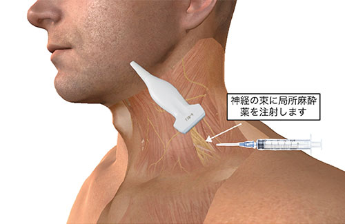 肩関節受動術